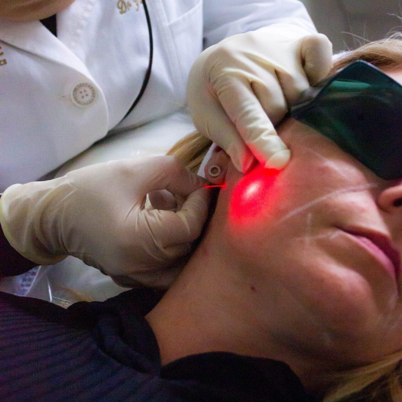 Endolift Treatment in progress