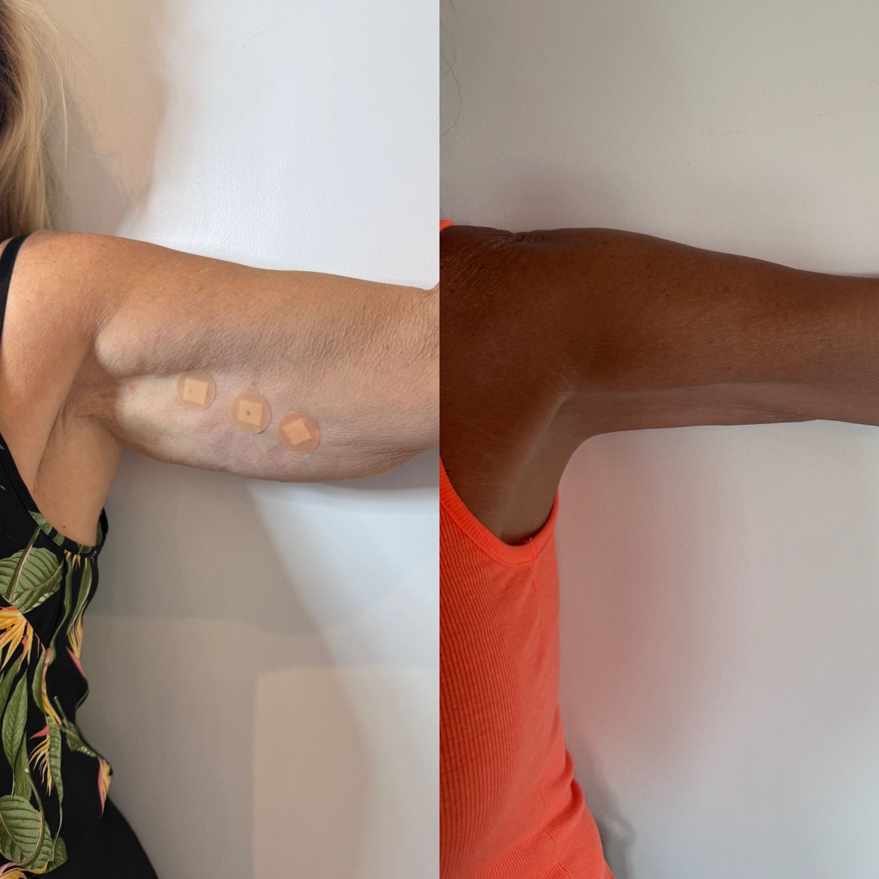 Bingo wings before and after — upper arm skin tightening