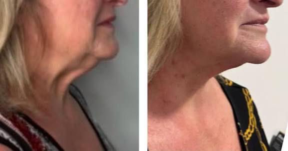 Neck & Jowl Tightening